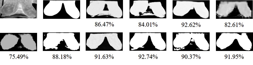 Infrared Breast.jpg