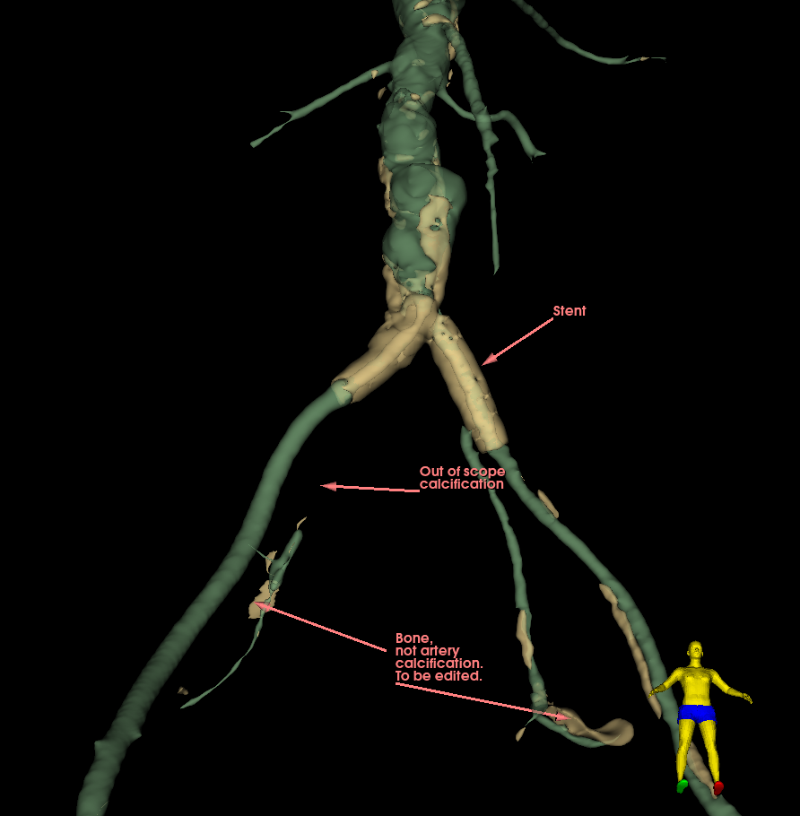 ArterialCalcificationPreProcessor_1.png