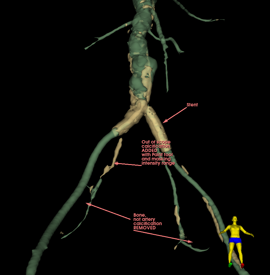 ArterialCalcificationPreProcessor_2.png